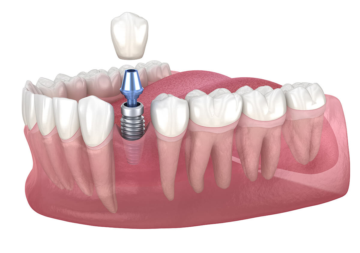 4 benefits of implants to replace teeth and rebuild smiles
