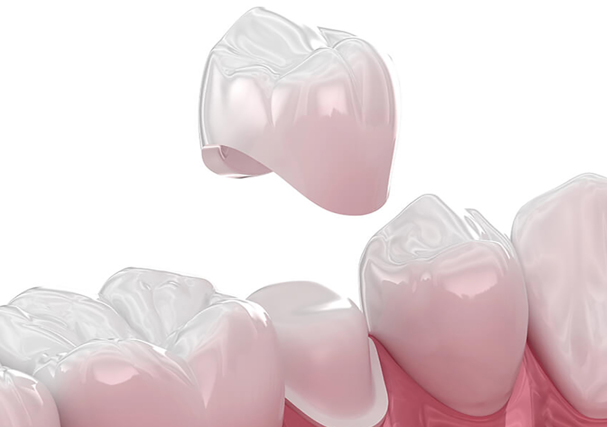 Getting Dental Crowns in Edmond OK Area