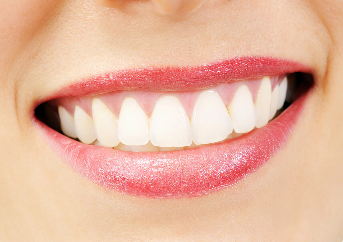 Getting Teeth Veneers in Edmond OK Area