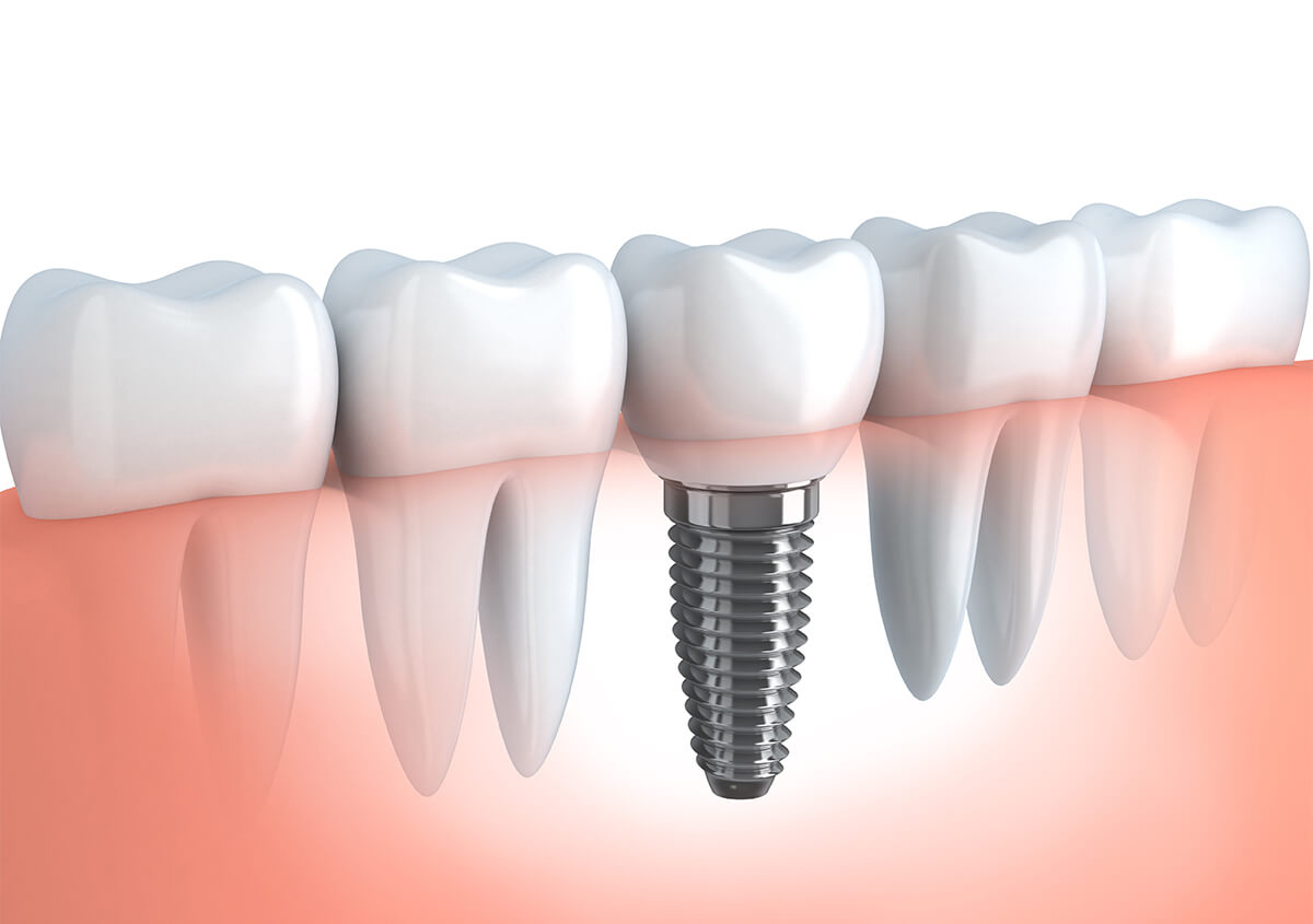 Considering Dental Implants? Get the Answers to Your Questions in Edmond, OK