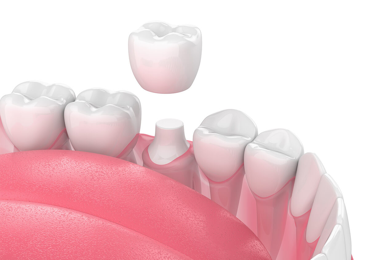 Same Day Tooth Crown in Edmond OK Area